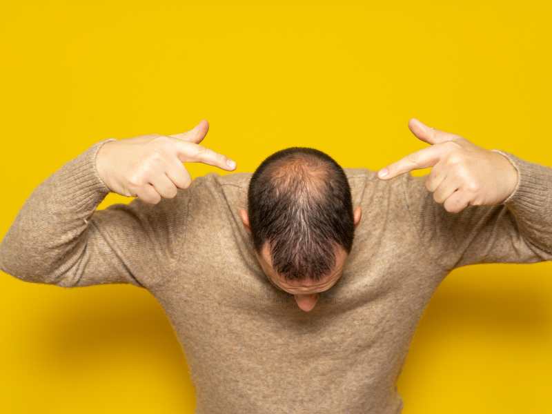 man-showing-the-effect-of-stress-on-his-hair