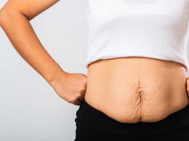 woman-showing-stretch-mark-loose-lower-abdomen-skin-fat-after-pregnancy