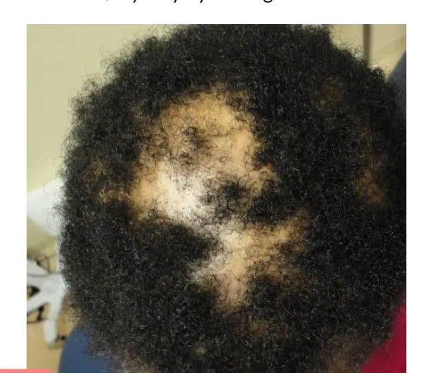 fungal-hair