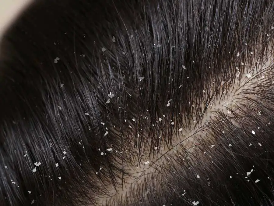dandruff-best-hair-growth-tip